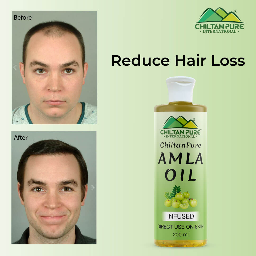 Amla oil Does it really work for hair growth