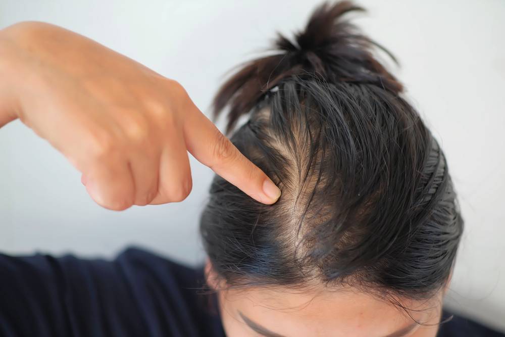 Comment se laver les cheveux pour éviter le psoriasis du cuir chevelu ?-1