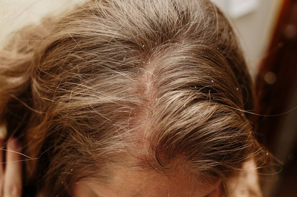 Le psoriasis du cuir chevelu et la croissance des cheveux — BIOPHYTUM