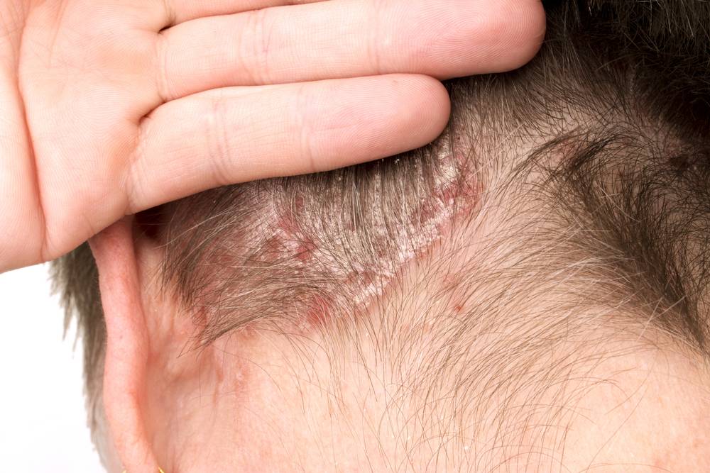 Irritation du cuir chevelu et psoriasis : quelles différences ?-2