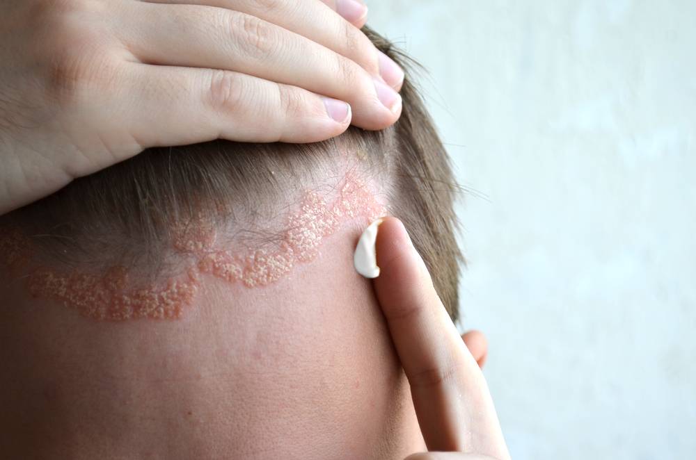 Le psoriasis du cuir chevelu : une maladie fréquente ? — BIOPHYTUM