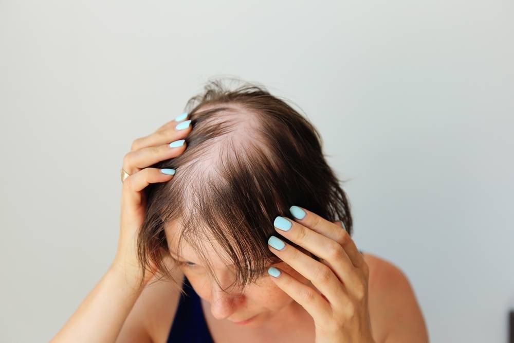 Pourquoi le psoriasis du cuir chevelu entraîne-t-il une perte de cheveux ?-1