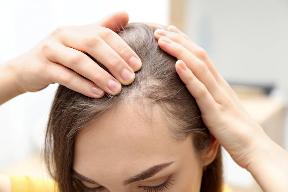 Psoriasis et perte de cheveux — BIOPHYTUM