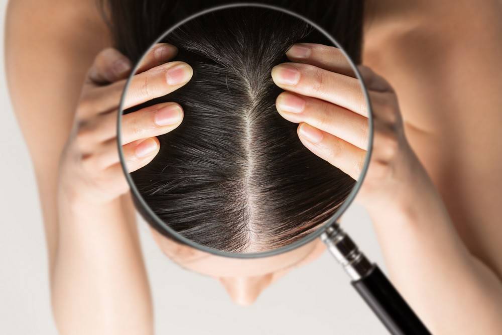 Quel rôle joue le système immunitaire dans le développement du psoriasis des cheveux ?-1
