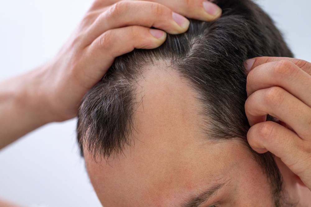 Quels sont les symptômes du psoriasis des cheveux ?-2