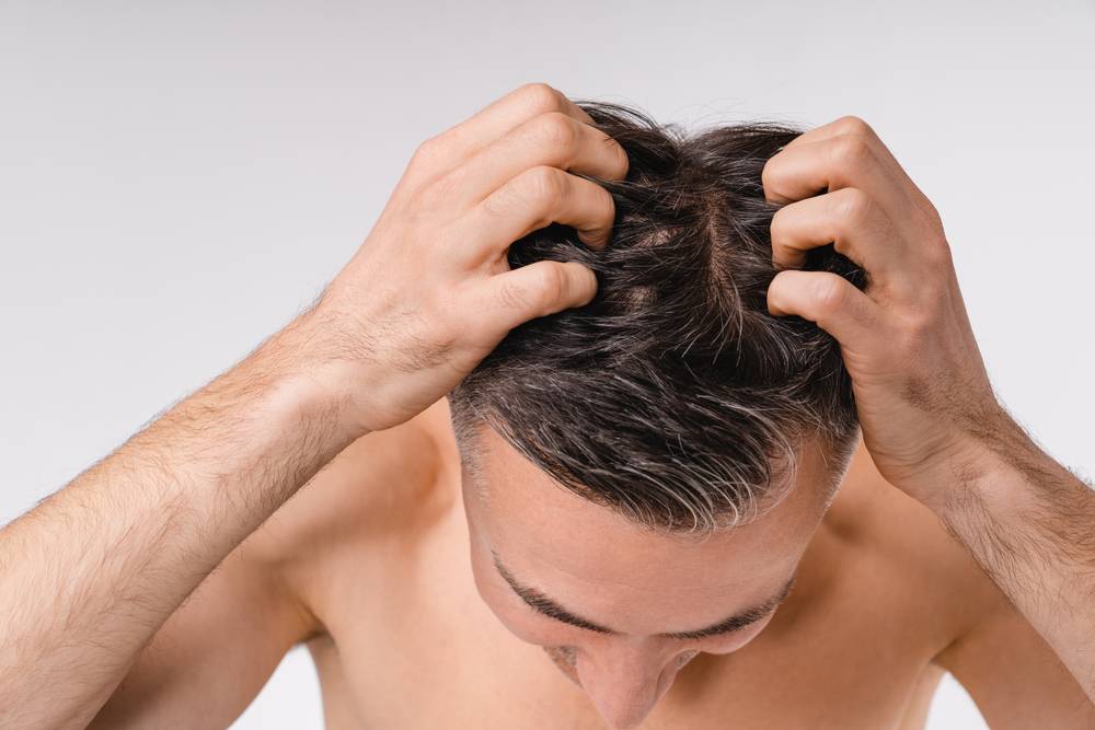 Qui est le plus concerné par le psoriasis des cheveux ?-2