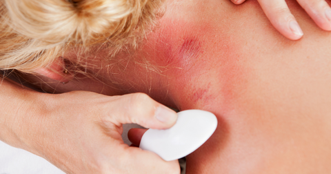 Gua sha treatment with Sha appearing on the skin