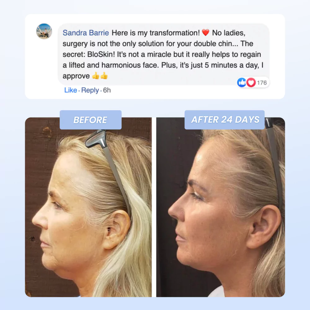 'Before and after side profile comparison of a woman's facial transformation.'