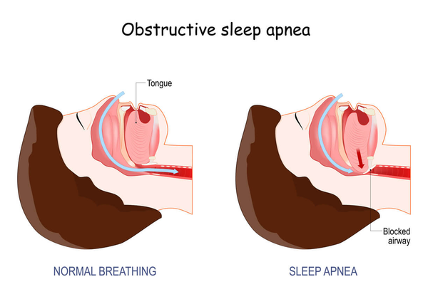 cpap therapy