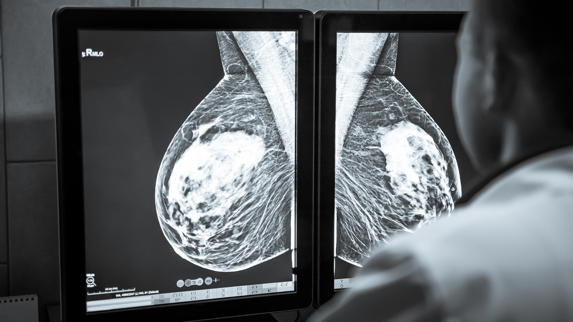 Mammography Display