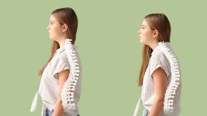 Understanding Scoliosis