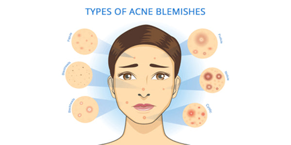 acne treat