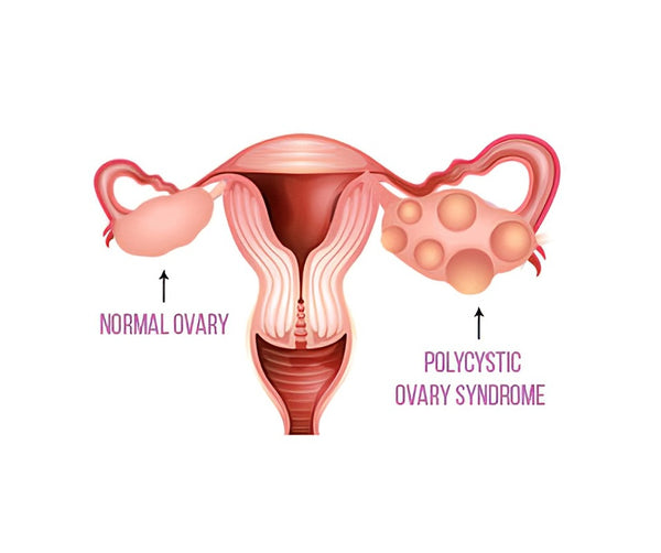 pcos-treatment