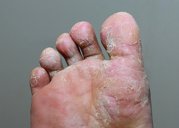 athlete-foot-tinea-pedis