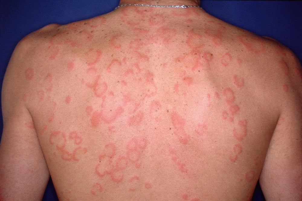 hives-urticaria-skin-care