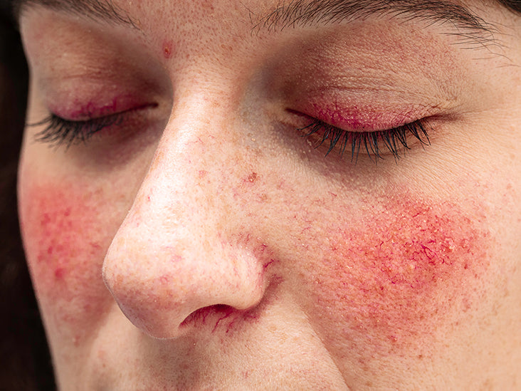 rosacea-allergies