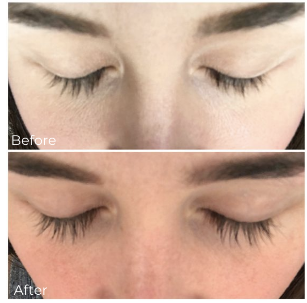 eyelash growth serum before and after example 1