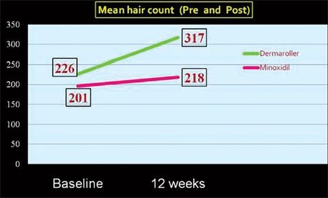 dermaroller-vs-minoxidil1