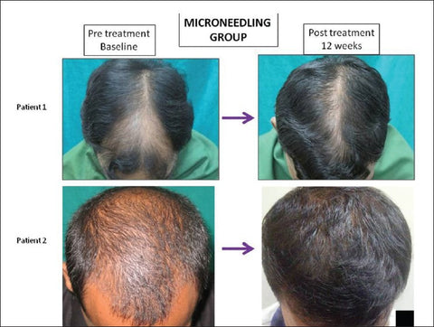 dermaroller-vs-minoxidil2