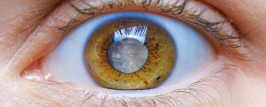 Eye with cataracts