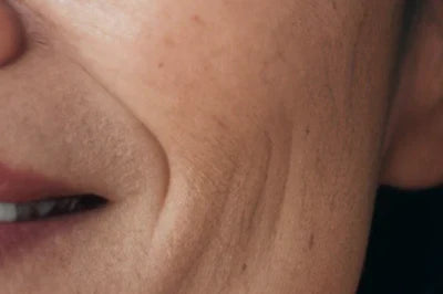 Fine Lines & Wrinkles