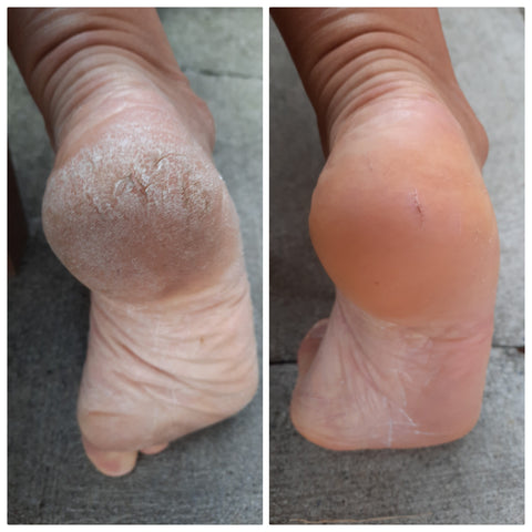 Oveallgo™ Foot Callus Removal Spray
