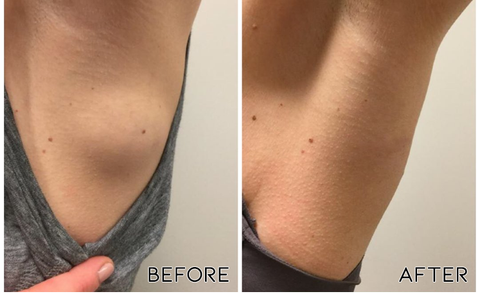 LipoPRO™ Lipoma Removal Cream