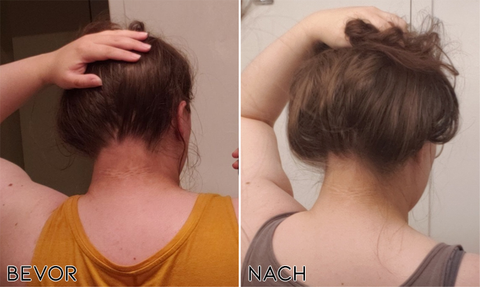 Fivfivgo™ Acanthosis Nigricans Behandlung Seife aus Bambuskohle 