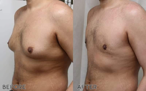 ChestIgnitePLUS Gynecomastia Targeted Heating Balm