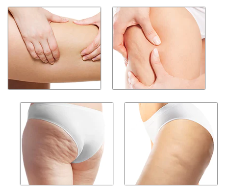 Fivfivgo™ MugwortsLegs Cellulite-Reduktionspflaster