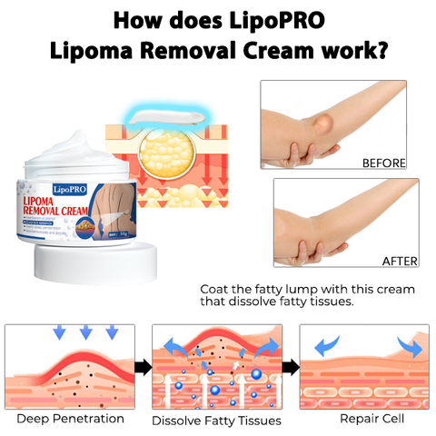 LipoPRO™ Lipoma Removal Cream