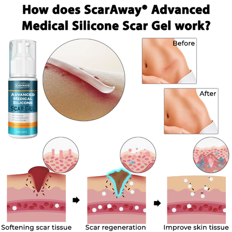 ScarAway® Advanced Medical Silicone Scar Gel 