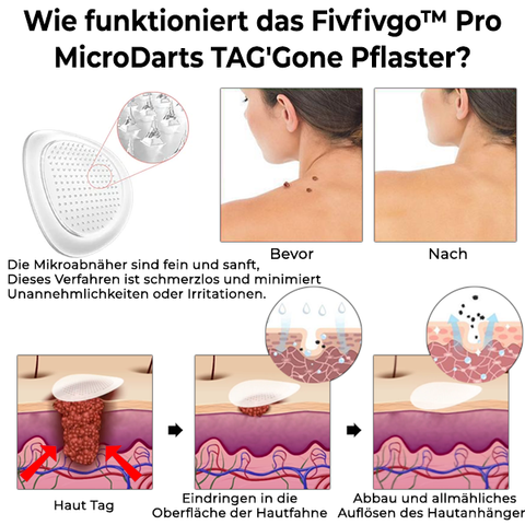 Fivfivgo™ Pro MicroDarts TAG'Gone Pflaster