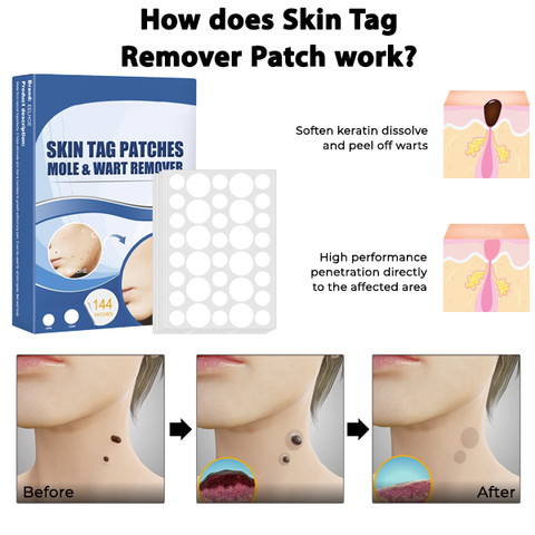 MaxPerformance Skin Tag Remover Patch