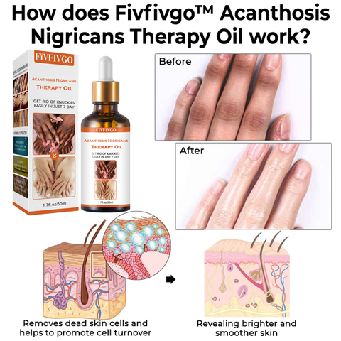 Fivfivgo™ Acanthosis Nigricans Therapy Oil 