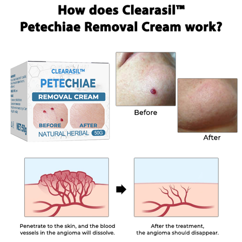 Clearasil™ Petechiae Removal Cream 