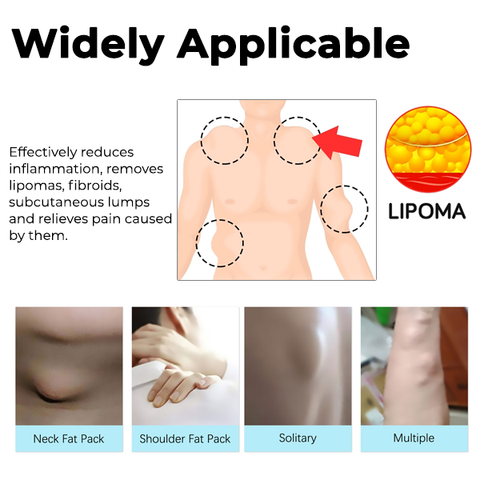 LumpFree™ Lipoma Removal Cream 