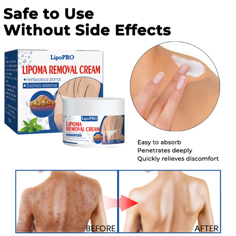 LipoPRO™ Lipoma Removal Cream