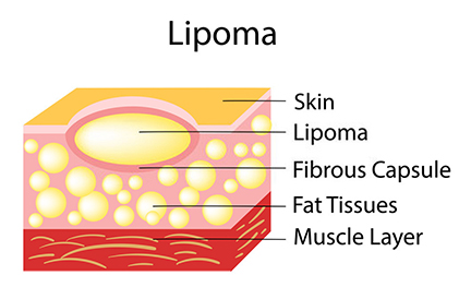 LumpFree™ Lipoma Removal Cream
