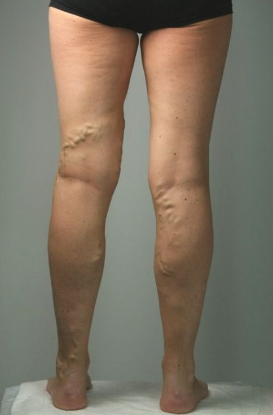 Oveallgo™ VeinHealing Varicose Veins Treatment Spray