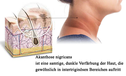 Fivfivgo™ Acanthosis Nigricans Behandlung Seife aus Bambuskohle 