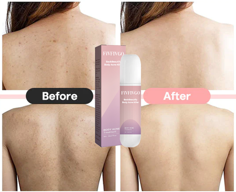 CC™ BackBeautify Body Acne Killer