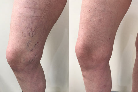 Oveallgo™ VeinHealing Varicose Veins Treatment Spray