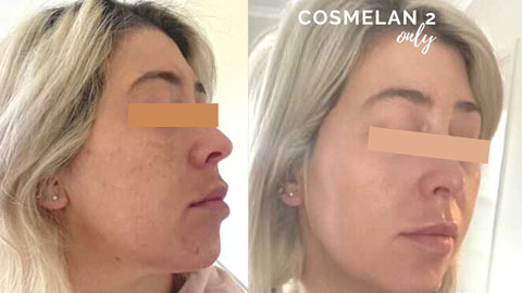 No Professional Peel just Cosmelan 2