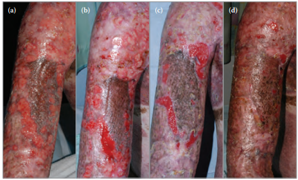 Burn wound dressing