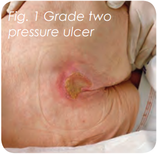 Pressure ulcer grading 2