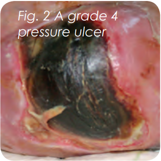 Pressure ulcer grading 4