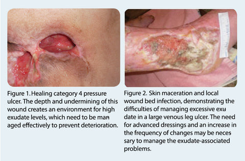 Leg Ulcer Pictures