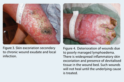 Leg Ulcer Pictures