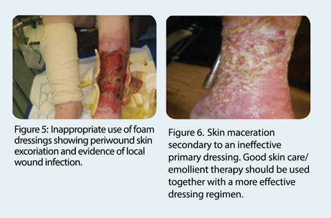 Leg Ulcer Pictures